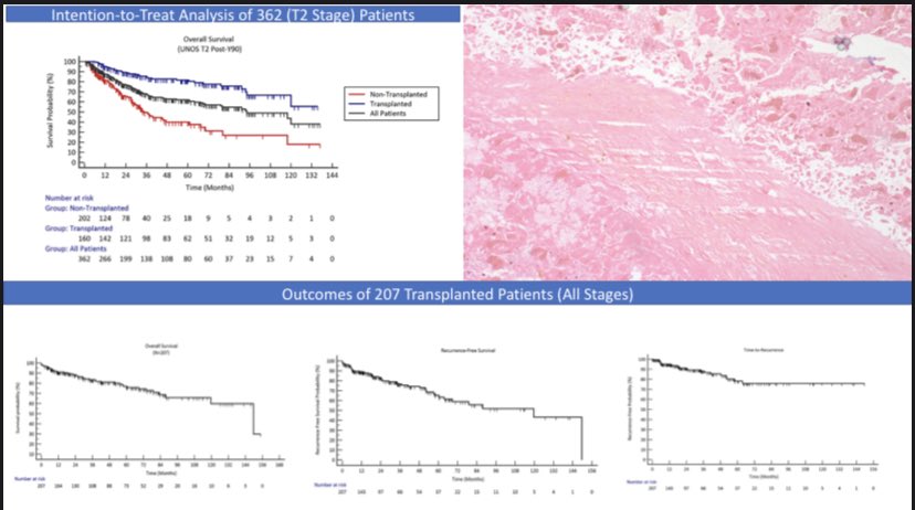HEP_Journal's tweet photo. Long term survival of #transplantation post #Y90 radioembolization https://t.co/tDKFwHpDPM https://t.co/ZpsR7IIgzx