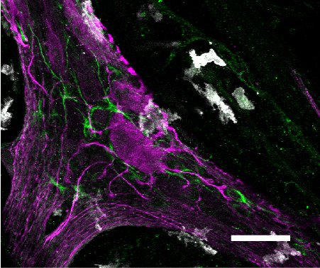 Today 11am @3RRRFM #20phds20mins with @DrShaneRRR  I'll be talking about how the gut nervous system uses other cells to help it communicate. See below a big pink gut nerve cell surrounded by green glue cells (glia) cuddling up to immune cells in white (macrophages)
