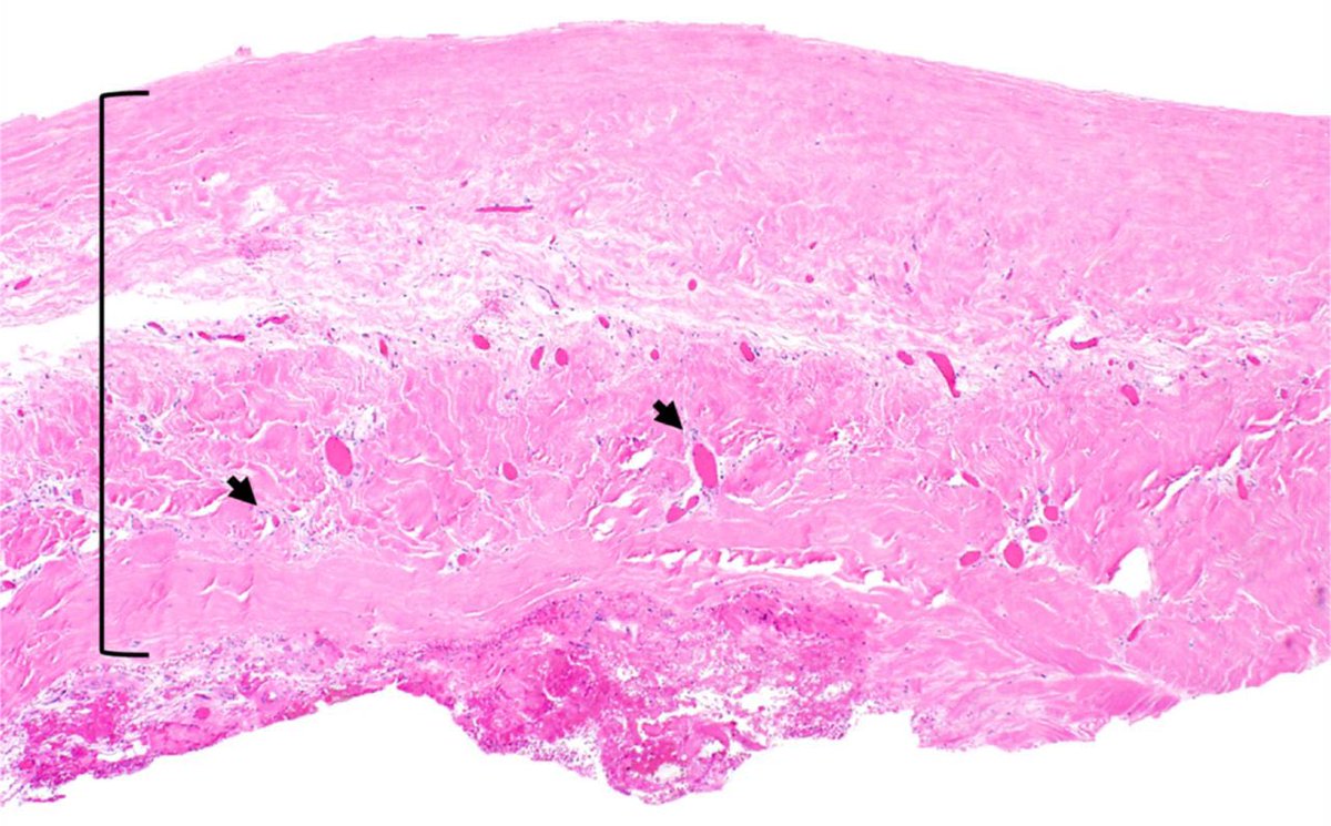 JGrapsa's tweet photo. Dr. Logan Vincent & colleagues describe a patient with #constrictive #pericarditis post lung Tx #JACCCaseReports : https://t.co/MVvfb3pPjY @JACCJournals @EstefaniaOS @KevinShahMD @gina_lundberg @MinnowWalsh @purviparwani @argulian @mividovich @rafavidalperez @fischman_david https://t.co/Pxb2xdHsQi