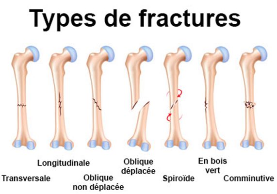 MondSanite's tweet photo. https://t.co/TQqHvHcJzo

#Frakti #nan #nan #zo #tibia 
✅Frakti nan zo tibia se frakti dyafizyè ki pi frekan nan òganism lan. ✅Yon frakti tabial kapab pwodwi nan nenpòt kote olon de zo sa e ki kapab fè dè ti fissure jiska yon ripti konplèt ki ka pèmèt separasyon zo a. https://t.co/fsllI4QAb5