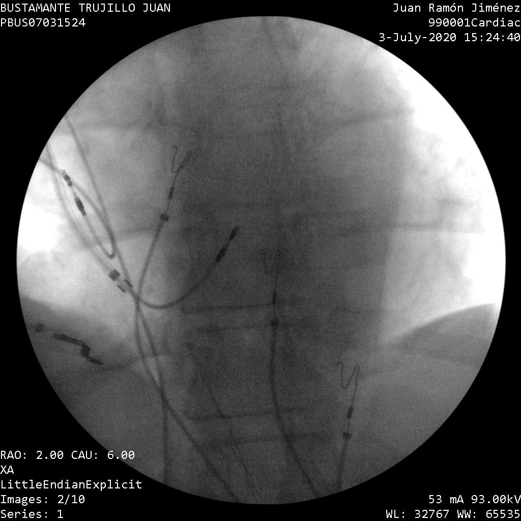 Dr_Pmorina's tweet photo. Fortunately, after 20 years of #Hispacing, both physicians and companies have become convinced that #physiological# pacing is possible and safe New tools are being developed to improve results. #AgilisHisPro. Position of cables before peeling . https://t.co/Pj29qXXrKk