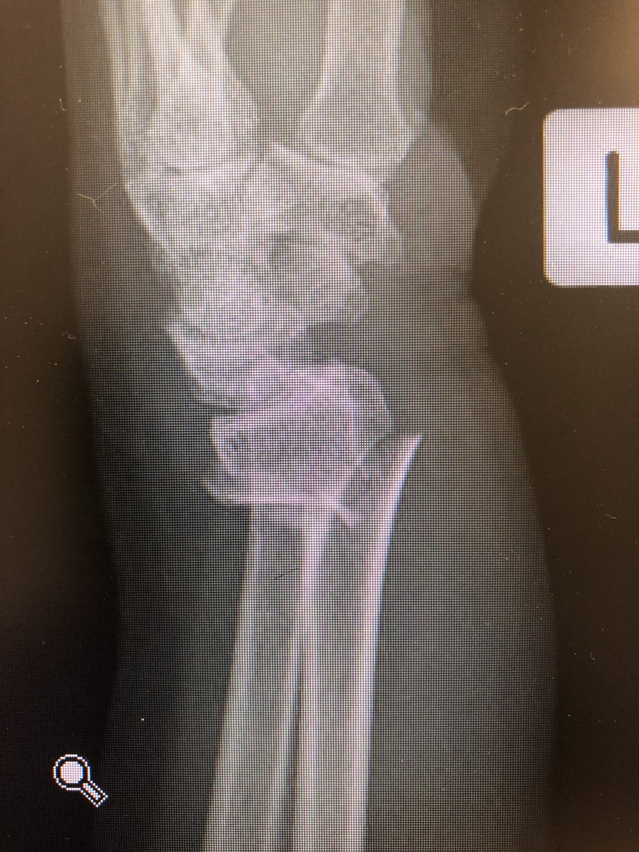 Simple everyday distal radius fracture. 60 yr old nurse. Medically well.  #OrthoTwitter