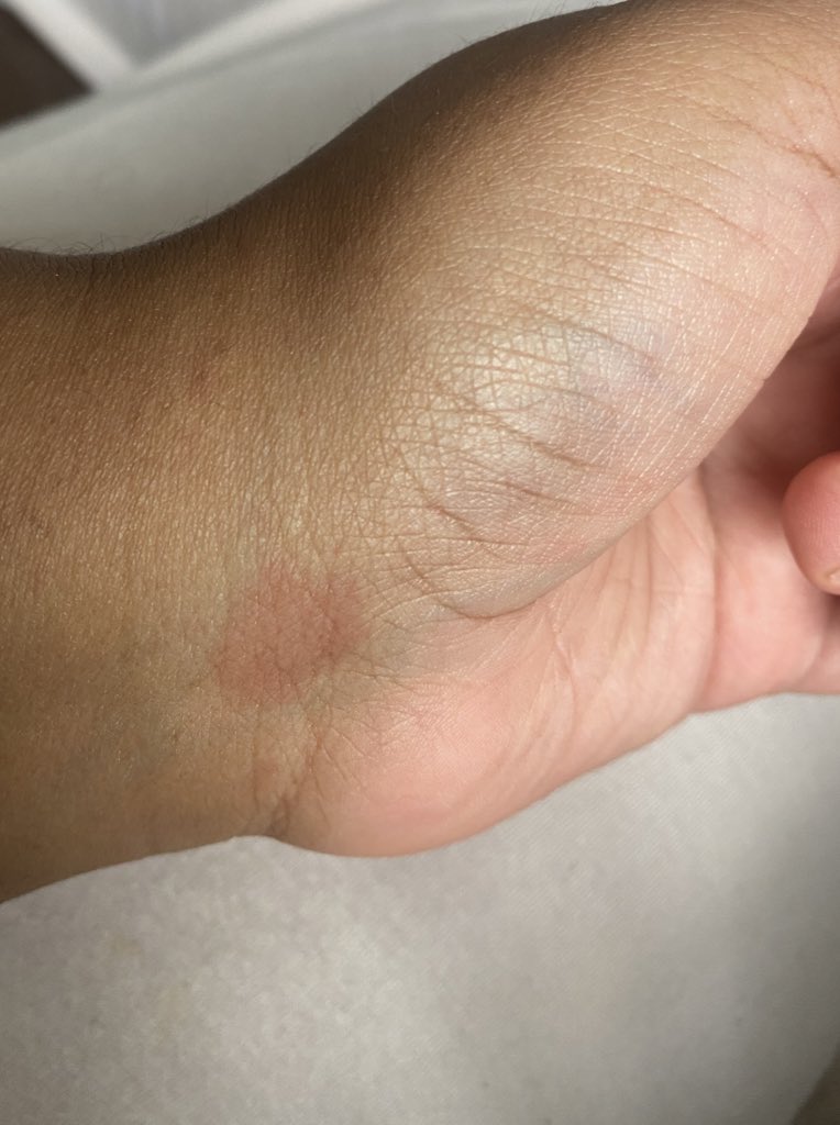 Is there any data on covid also triggering skin conditions? I’ve been getting these random red spots all over my body. Never ever had this pre-covid. They’re not itchy or raised. They’re just.....there.
