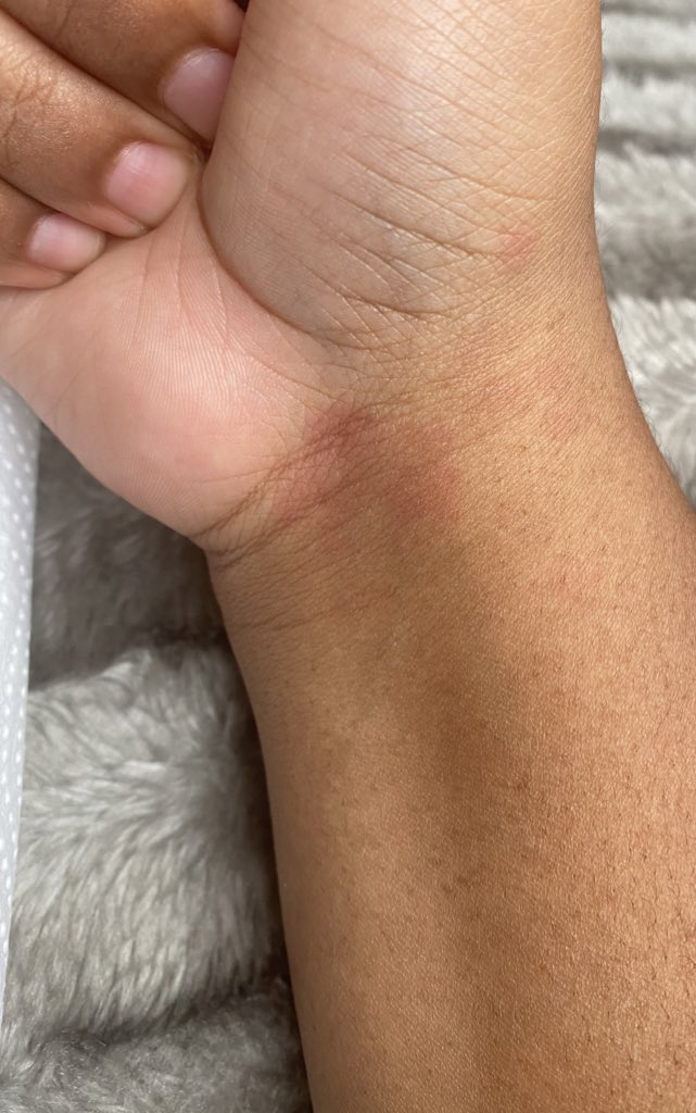 Is there any data on covid also triggering skin conditions? I’ve been getting these random red spots all over my body. Never ever had this pre-covid. They’re not itchy or raised. They’re just.....there.