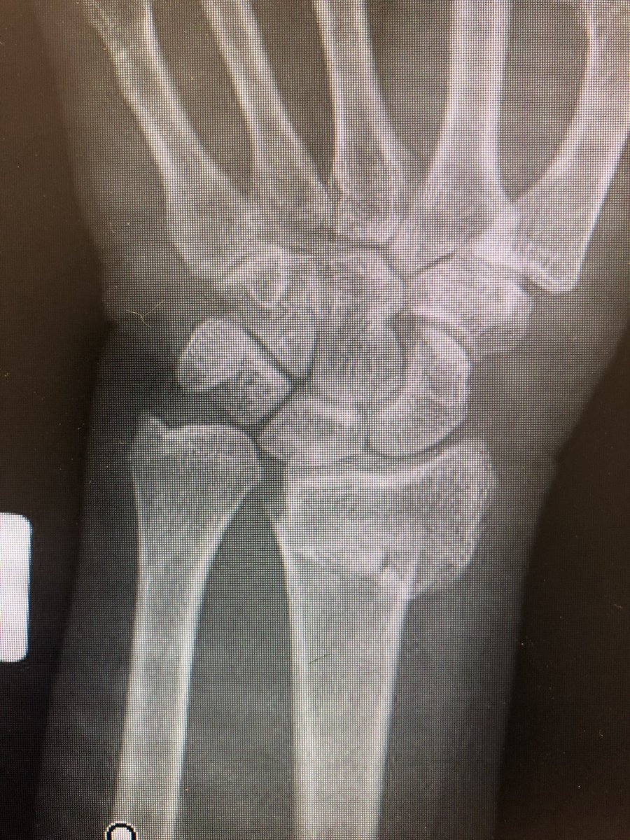 I see conventionally this would be called an ‘extra-articular’ fracture. Do we oversimplify this? Isn’t DRUJ a ‘joint’? Isn’t the distal ulna getting all into the business of the carpals a ‘joint disruption’? I would fix this.