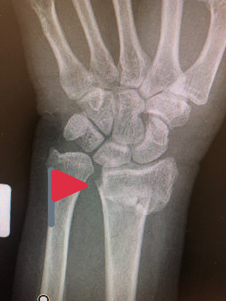 Point 1: The proximal fragment radius spike has a risk of translational mal-reduction and this can bother rotation of the forearm. Reduce this by putting a ‘lamina spreader’ in the inter-osseus space Before locking the shaft screws and clear the DRUJ.