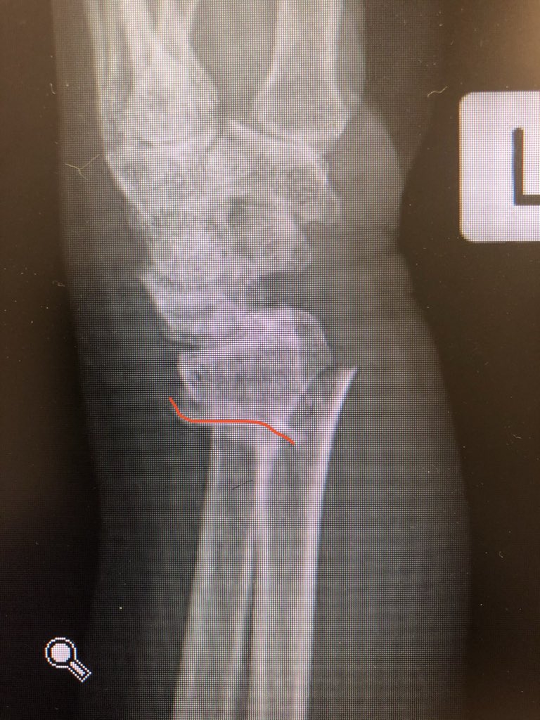 Point 2: The dorsal metaphyseal comminution. The dorsal cortex fragment is ‘fallen in’ inside the osteoporotic metaphyseal void. I addressed this after plating finished, made a 4.5 mm drill hole in the ‘window’ of the plate to push the fragment and fill in graft substitute.