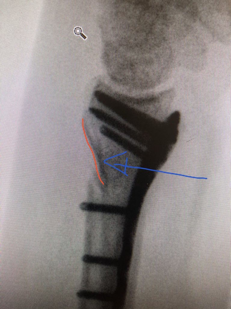 Point 2: The dorsal metaphyseal comminution. The dorsal cortex fragment is ‘fallen in’ inside the osteoporotic metaphyseal void. I addressed this after plating finished, made a 4.5 mm drill hole in the ‘window’ of the plate to push the fragment and fill in graft substitute.