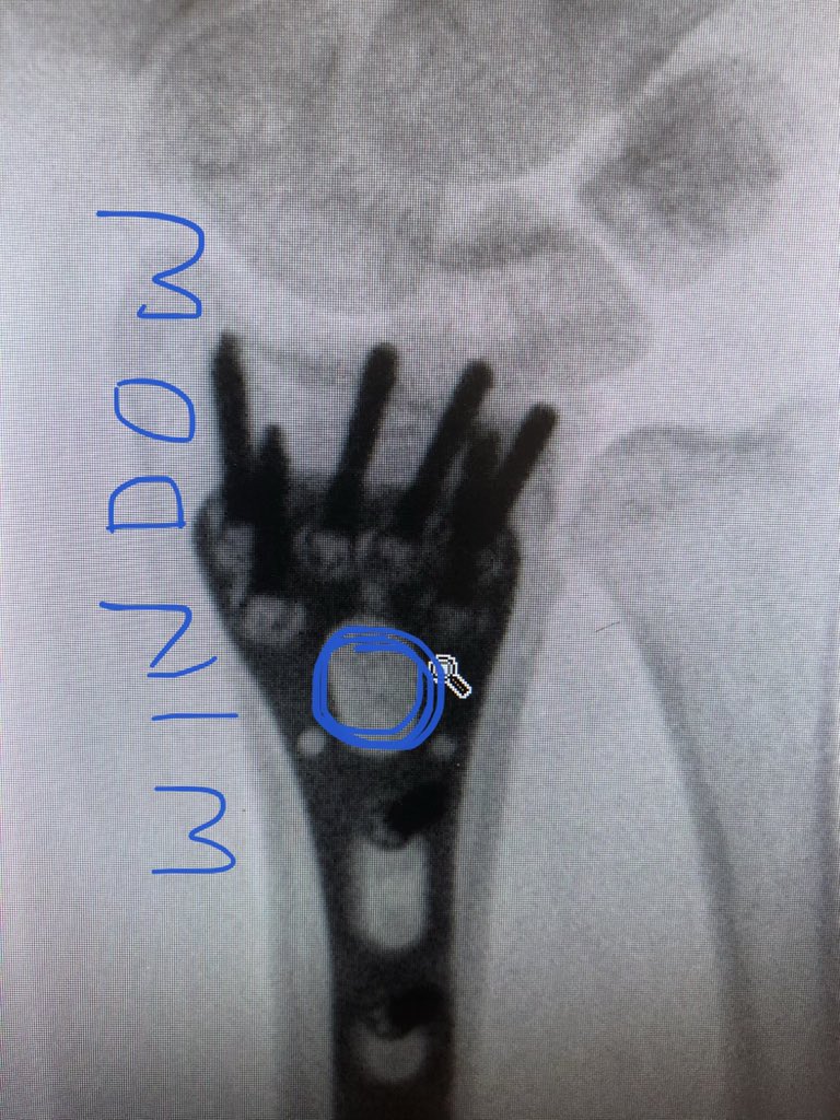 Point 2: The dorsal metaphyseal comminution. The dorsal cortex fragment is ‘fallen in’ inside the osteoporotic metaphyseal void. I addressed this after plating finished, made a 4.5 mm drill hole in the ‘window’ of the plate to push the fragment and fill in graft substitute.