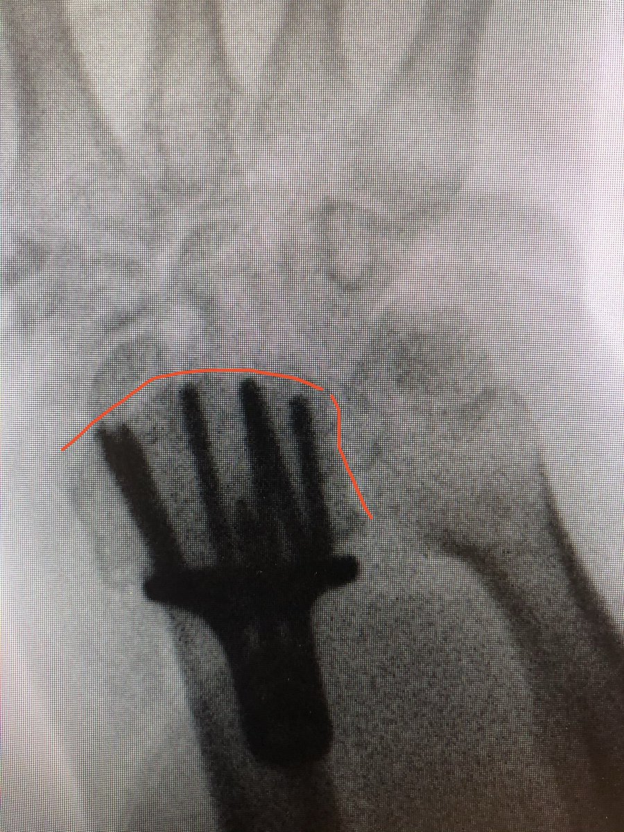 As compared to the dorsal tangential view, this DRUJ view gives better light contrast to view the dorsal rim and also additional information about the DRUJ to make sure there is no screw protrusion into the ulnar notch.