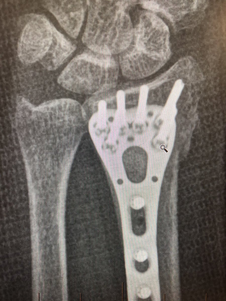 This was the patient at 2 weeks. Already on range of motion. The flat lateral X-ray always looks like the screws are in the joint. That’s because of the distal radius joint inclination angle. Take intra-operative 20 degree elevated lateral shot to see through the joint.