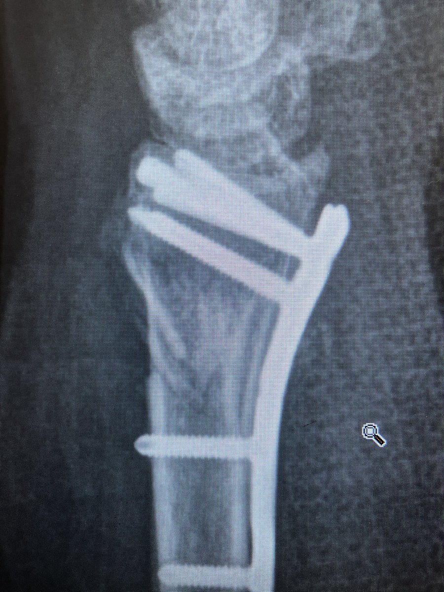 This was the patient at 2 weeks. Already on range of motion. The flat lateral X-ray always looks like the screws are in the joint. That’s because of the distal radius joint inclination angle. Take intra-operative 20 degree elevated lateral shot to see through the joint.