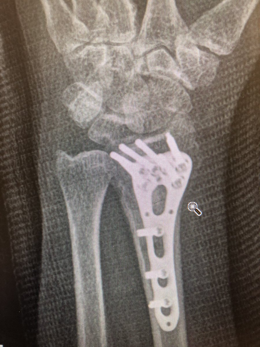 This was the patient at 2 weeks. Already on range of motion. The flat lateral X-ray always looks like the screws are in the joint. That’s because of the distal radius joint inclination angle. Take intra-operative 20 degree elevated lateral shot to see through the joint.