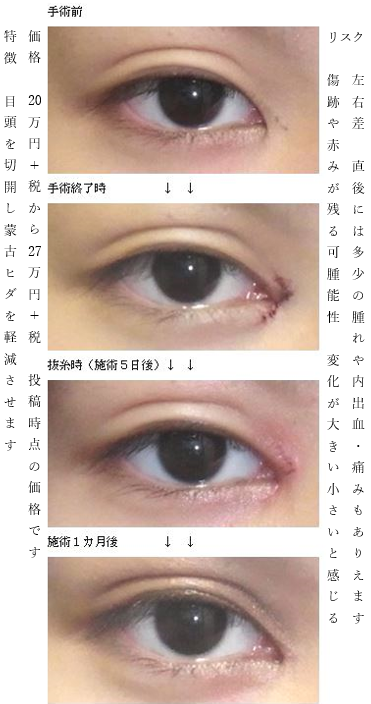 蒙古ひだ 蒙古ひだ