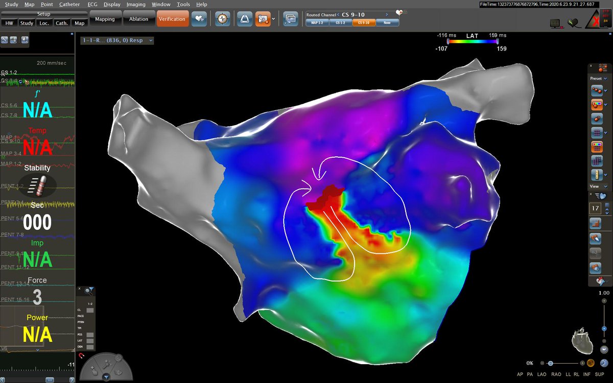 Dual loop reentrant post-AF ablation AT. Beautiful 3-D image (CARTO 3). EGMs recorded at the common isthmus “speak” for themselves and guide successful ablation. Negative PPI with high output pacing entrainment at this site. EP is only EGMs, and nothing more. #EPeeps