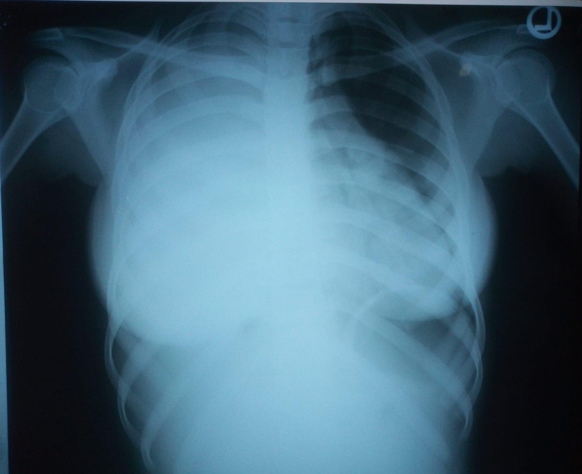 Nurse_toyin's tweet photo. Chest X-ray of an 18 years old girl https://t.co/TKKvY4nn1a