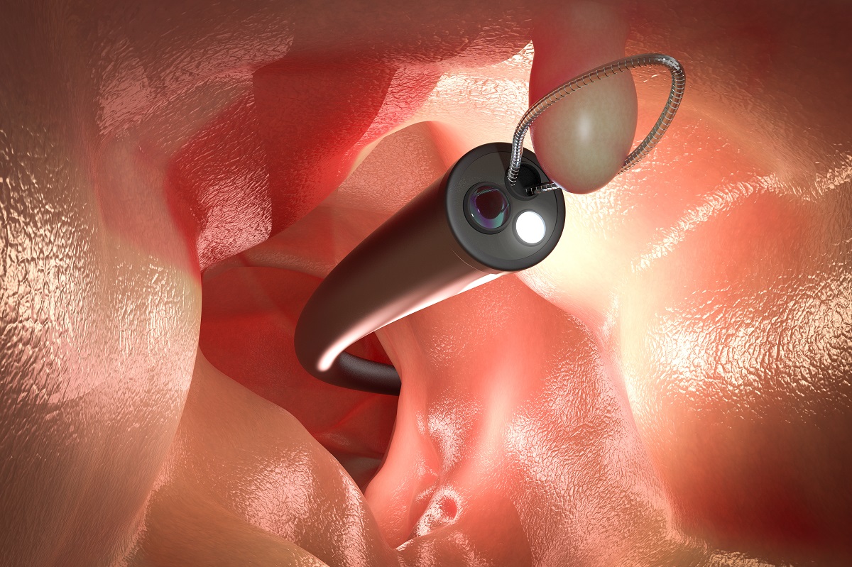 Endoscopic Management of Duodenal Polyps in Familial Adenomatous Polyposis jwat.ch/2BjGc7G #FamilialAdenomatousPolyposis <a href="/GIE_Journal/">GIE</a>