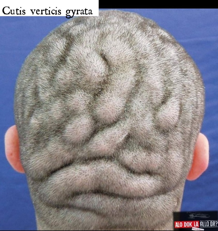 Docteur_Perrin's tweet photo. #8
Alo Dòk La

"Cutis verticis gyrata"
Se yon maladi nou jwenn kay gason, kote po tèt la ipètwofie, di, pwès li fome plizyè siyon. Li kapab parèt konsa se fòm primitif la a, konsa a tou se de seri maladi kwonik ki kapab koze l se fòm segondè a. E se pa tout fwa li bay doulè. https://t.co/6WoDp1XTtX
