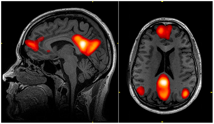 Why? Psychedelics does a good job of turning off the brains Default Mode Network (the ski hill).The default mode network is a brain structure that connect the cortex to the areas involved with memory, emotion & self reflection.