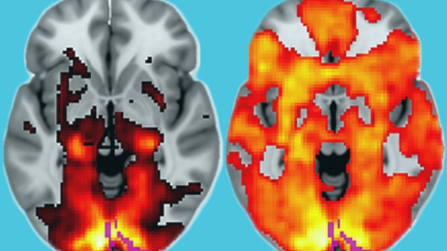 It's as if your brain lets its walls down & start communicating.Here’s an actual brain scan of someone on psychedelics (pic) What you’re seeing is normally segregated regions of the brain starting to interact with each other.
