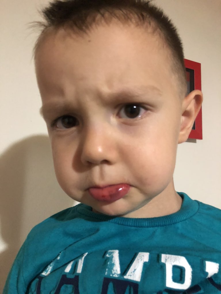 ‘ecoş dudağım çok acıyoy’q