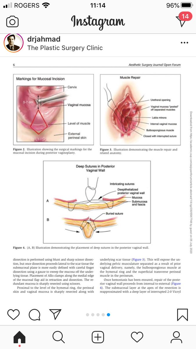  @FPMRS  @SocietyPelvic  @IUJ_BlueJournal  @jfitzgeraldMD  @dramypark  @DrJenGunter  @FionaMattatall  @DrJAhmad and colleagues publish the following. It highlights that gynecologists aren't considered surgeons. 1/