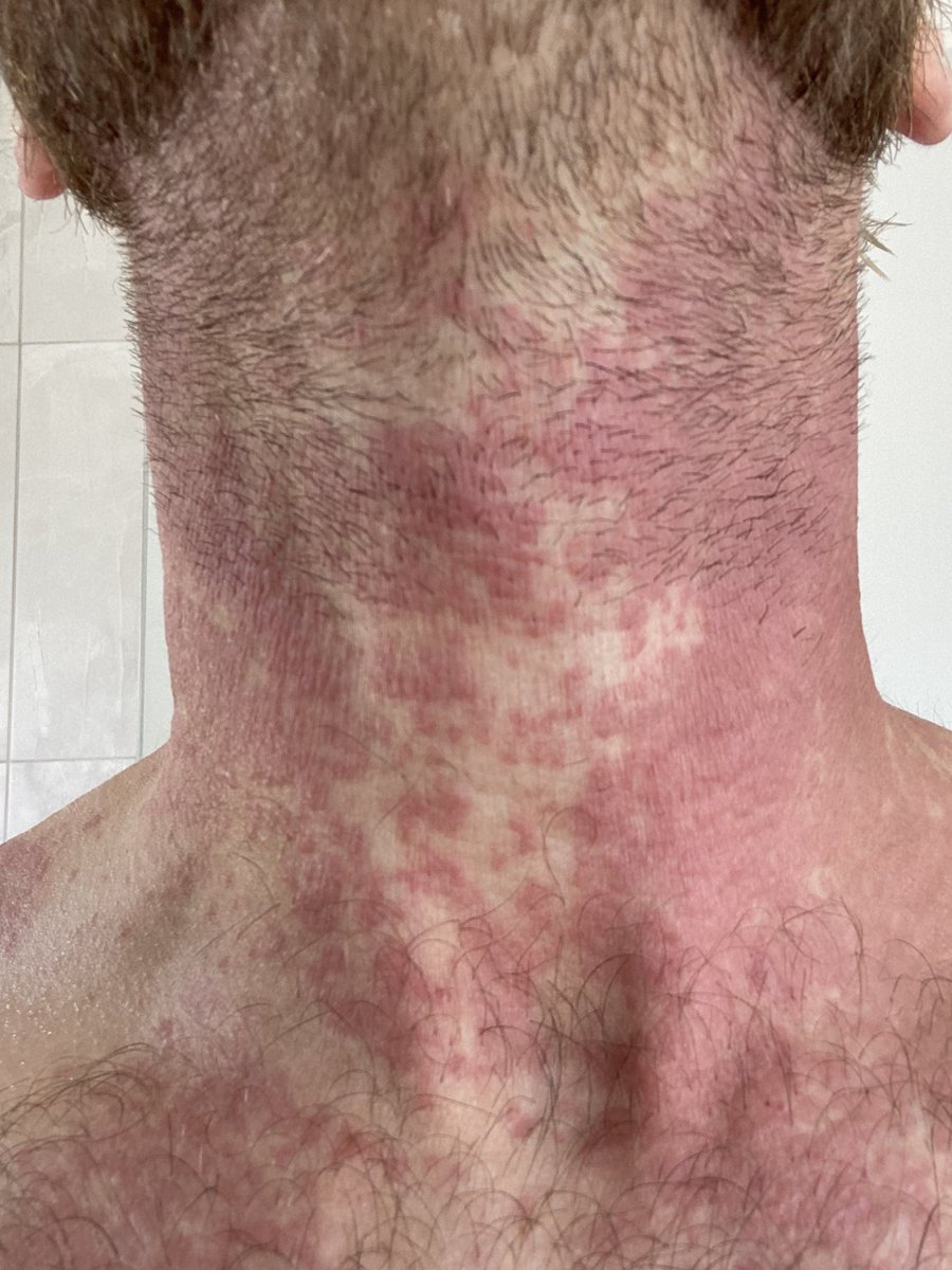 lukebrown07's tweet photo. Reaching out for any advice! @nationaleczema @eczemasociety From rashes, tightness, cracks, soars, seeping &amp; bleeding. Itchiness is barbaric :( #eczema #skin #dermatology #skincare @eczemaresearch @NHSHelp https://t.co/bdpjbKhOF2