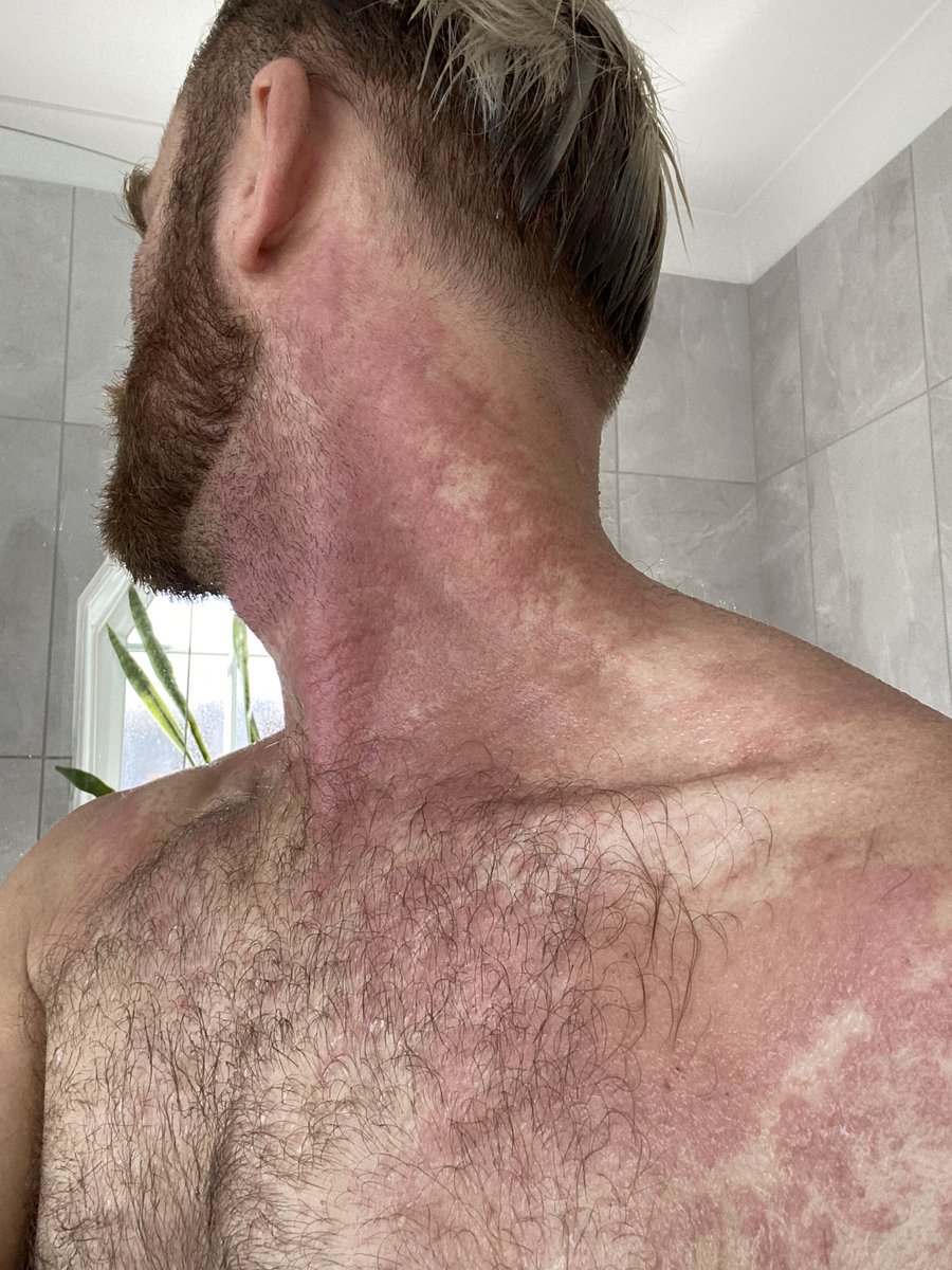 lukebrown07's tweet photo. Reaching out for any advice! @nationaleczema @eczemasociety From rashes, tightness, cracks, soars, seeping &amp; bleeding. Itchiness is barbaric :( #eczema #skin #dermatology #skincare @eczemaresearch @NHSHelp https://t.co/bdpjbKhOF2