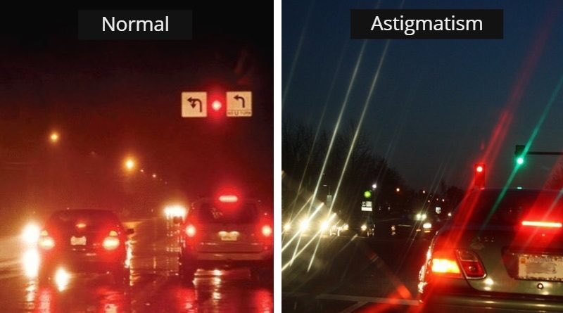 Having the eye focus on different points will cause blurry vision. This is particularly noticeable when looking at lights at night. Streaks and starbursts are common because the eye cannot focus all the light rays at the same time like somebody with a basketball cornea can