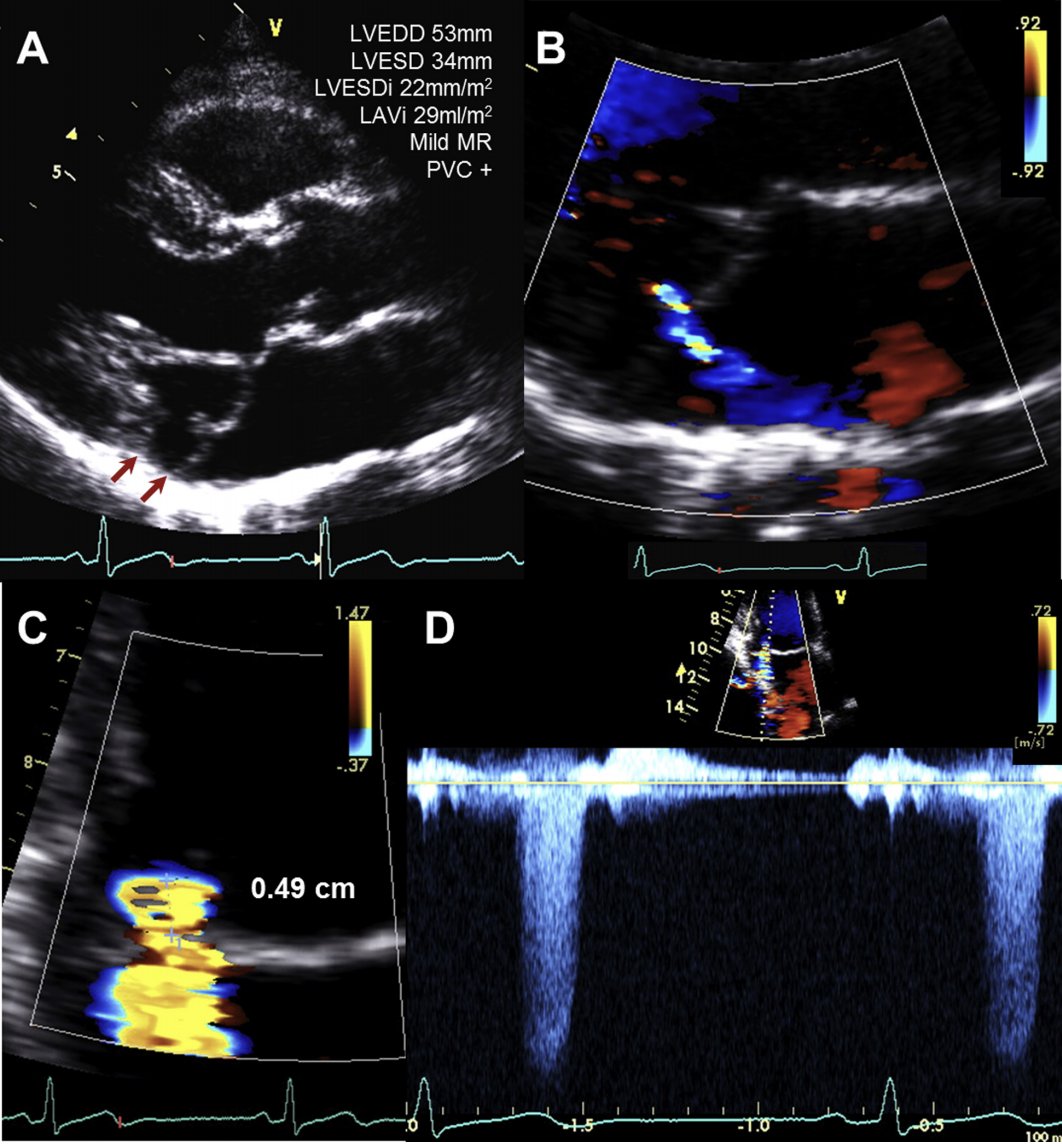 MVP Pts with &lt; Moderate MR Exhibit Early Cardiac Chamber Remodeling 

• LV remodeling in Pts is a/w MVP,♀, PVCs
• Posterior MVP is an independent predictor of MR progression
• Early LV &amp; LA remodeling doesn't predict MR 
progression or a/w mortality

bit.ly/2NPitPn