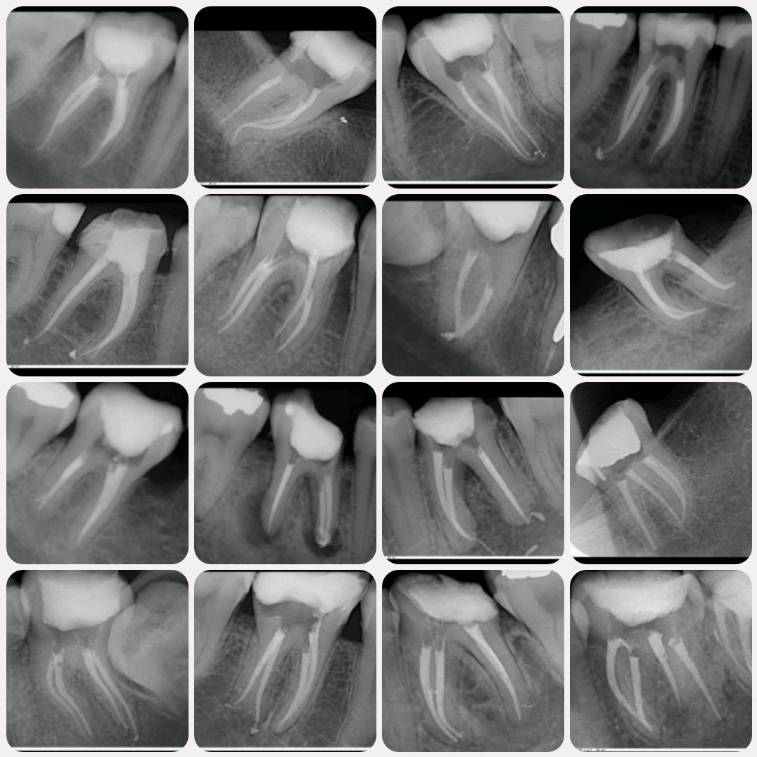 No matter how talented you are, your talent will fail you, if you are not skilled. Skill is achieved through practice. Work hard and dedicate yourself to being better every single day!

16 lower molars "made with love"