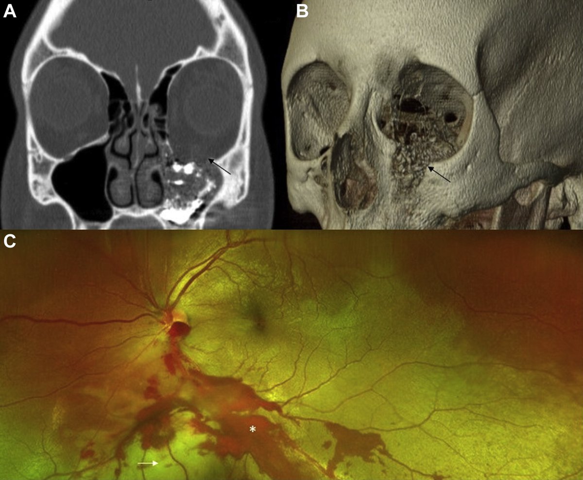 AAOjournal's tweet photo. Devastating and potentially blinding - the ophthalmic impact of a rubber bullet. #ophthalmology #NotOneMoreEye #NoRubberBullets #RubberBullets #protests2020 From: @EmoryEyeCenter https://t.co/VfHRfkPfpI https://t.co/BNnCZscTWr