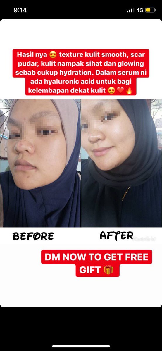 Hii cantikkk Iqa adalah authorised seller Mimpimika under  #teamyummy  COD AREA KUANTAN POSTAGE SELURUH MALAYSIA FREE SKINCARE GUIDE AND KNOWLEDGE DAPAT FREE GIFT Boleh terus whatsapp iqa yaa  https://linktr.ee/atqhszni 