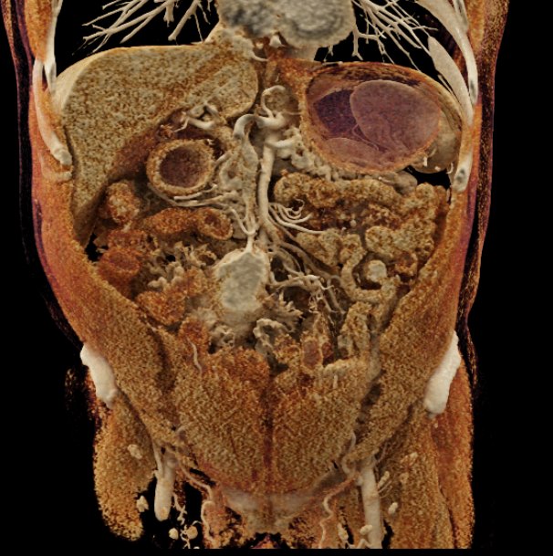 Carcinoid Tumor Small Bowel with Cinematic Rendering