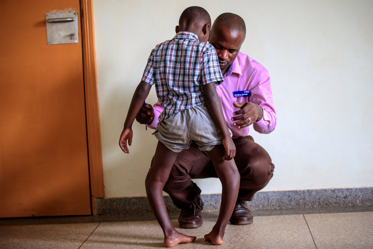 corsuhospital's tweet photo. Conditions like bowlegs if untreated at young age can lead to leg deformities, difficulty in walking, running &amp; in the longrun, result into arthritis. 
Join #FriendsofCoRSU by donating through https://t.co/LU3v0pkL2r or mobile money on 0784160169 to support treatment of bowlegs. https://t.co/Q3oIt8U0WL