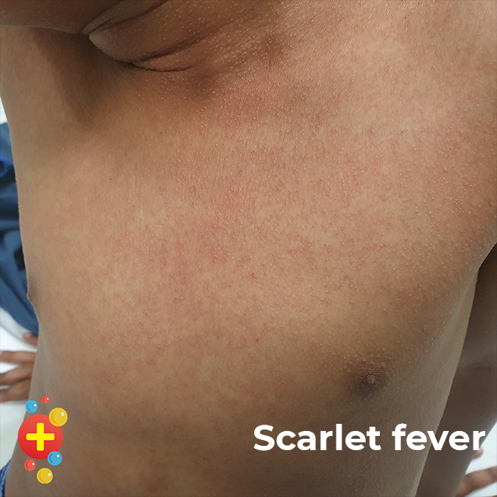 This image demonstrates scarlet fever.

It shows a bright red non-confluent eruption with very fine papules

This is part of our our brand new project, Skin Deep which aims to improve the diversity in skin images online.

dftbubbl.es/skindeep