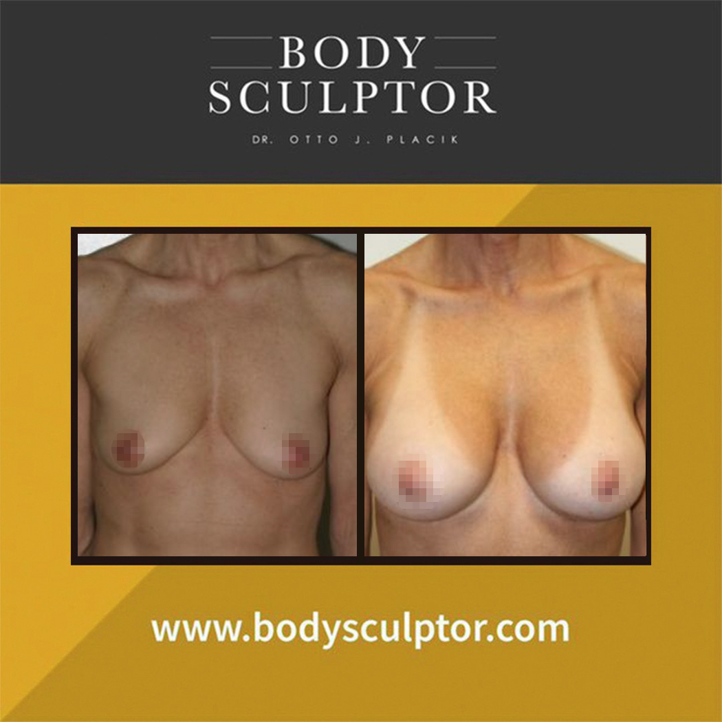 drplacik's tweet photo. Breast Revision | https://t.co/viCUQHhoZG https://t.co/MoyYvRnbOJ
