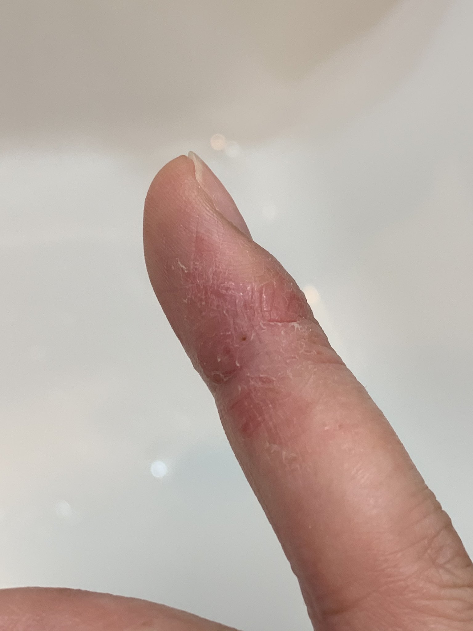 تويتر あじゅ على تويتر 裂け目は消えてなんか脱皮して肉肉しくなってしまった この指だけだからどうしたものか 指一本の荒れで皮膚科ってのも T Co Nwgwnkzsul