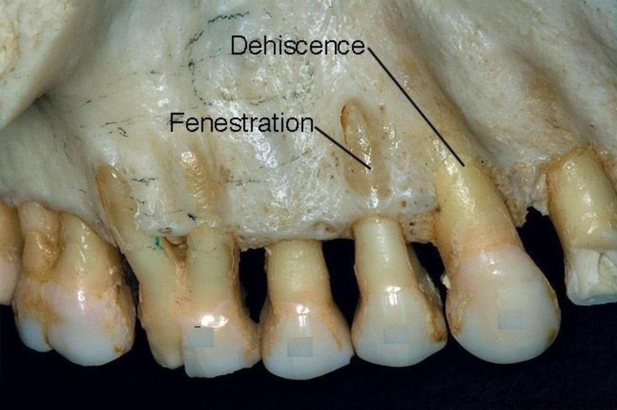 Dentagama's tweet photo. What is the difference between dental dehiscence and fenestration? https://t.co/QMfMhosM6E https://t.co/5OlIkqndyE