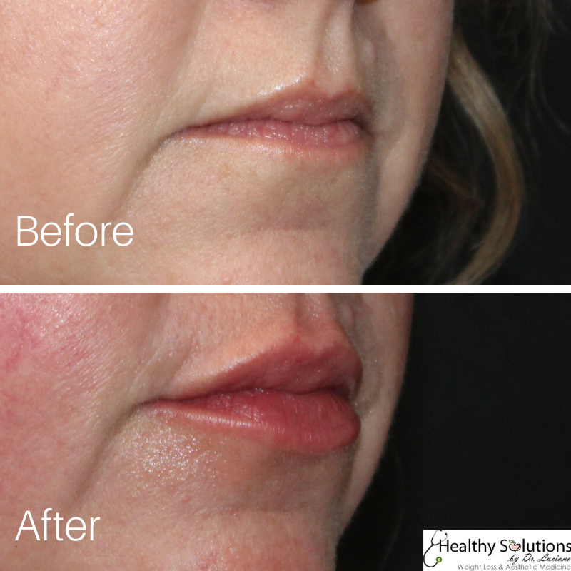 HlthySolMedSpa's tweet image. Love your lips at our #medspa
#buckscounty #buckscountypa #medicalspa #lips #lipinjections #lipfillers

Visit our website here:
healthysolutionsdr.com