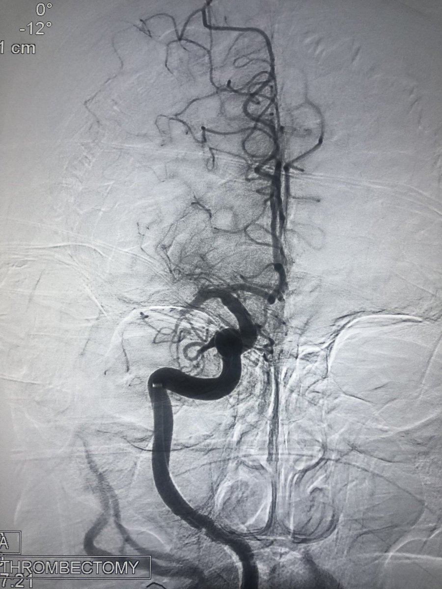 hldmak's tweet photo. Record speed for #stroke #thrombectomy. @BaltSpain @balt_usa #Ballast and #MIVI #Q6 snake. ⏰ 5 min puncture to TICI 3! Patient improved on table. D1 NIHSS 0. At @RLHINR. #leavenoELVObehind #spectrumstroke https://t.co/bTnYSJxsXc