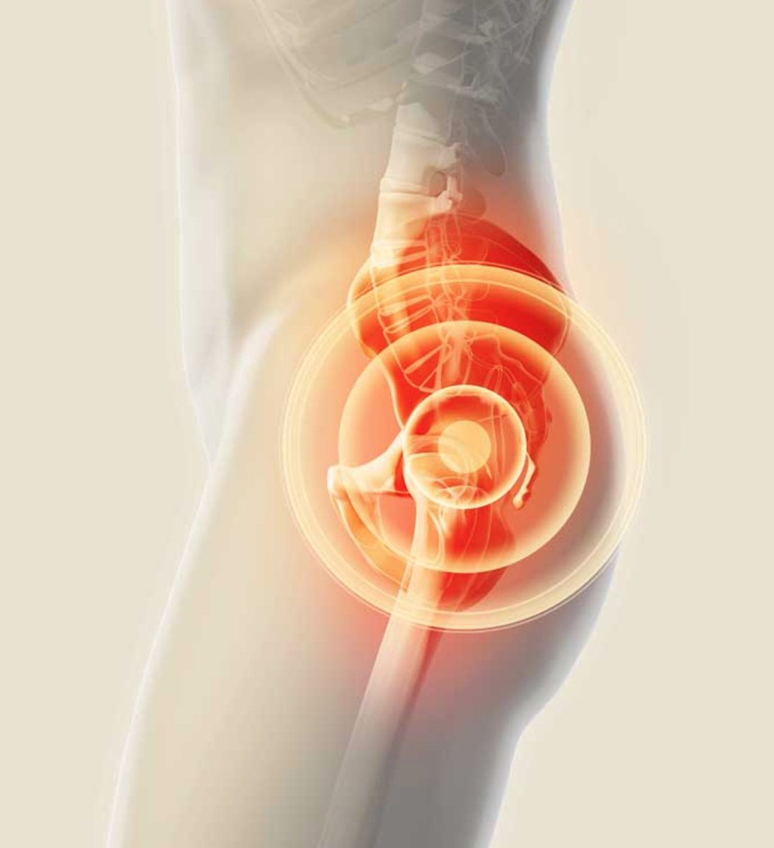 nashvilleorthos's tweet photo. Narrowing of the space between the #ischium and the lesser #trochanter of the femur is commonly present. X-rays can sometimes detect this. However, the most constant feature is injury to the quadratus femoris muscle with...https://t.co/0dEgEGTBR8 #orthotwitter https://t.co/TUfVMwv6gJ