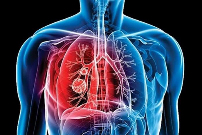 inbicu's tweet photo. Hablemos de Turbeculosis: Enfermedad prevenible, tratable y curable. 
Según la OMS la TB es una de las principales causas de enfermedad en el mundo, una de las 10 principales causas de muerte y la principal causa de muerte por un agente infeccioso único, por encima del VIH/sida. https://t.co/MbGZUXthsX