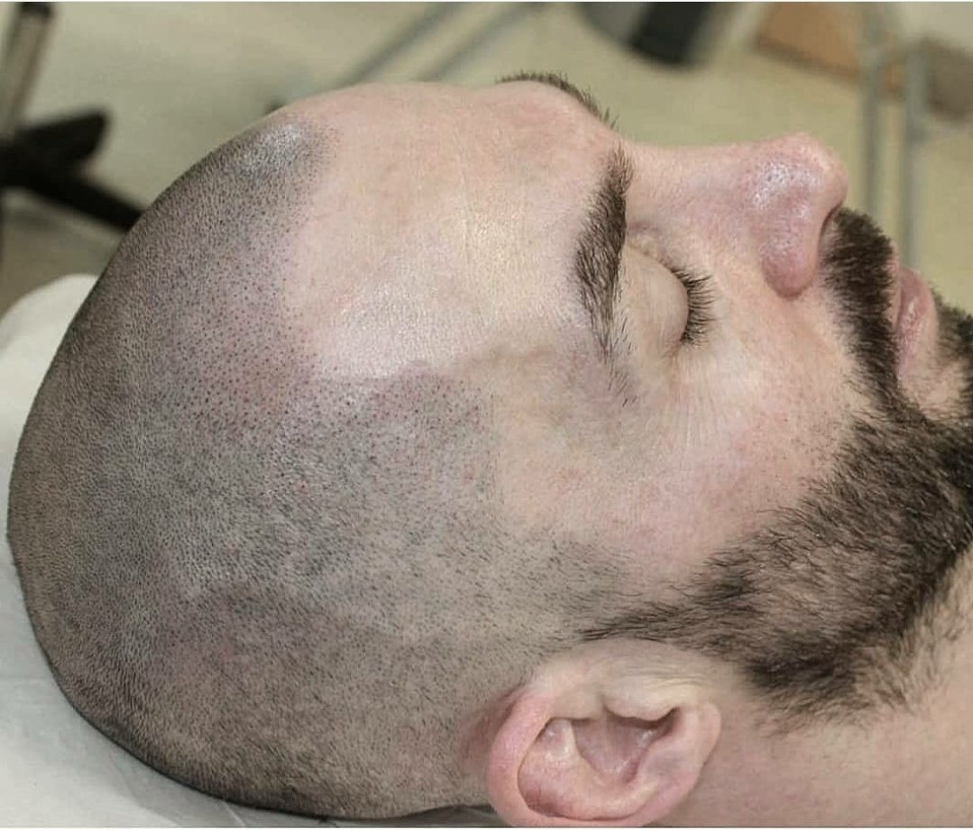 Jayharg's tweet photo. New hairline for this client.. 
Smp also know as scalp tattoo is a great treatment for receding hairlines , hair loss and desification..
.
.
#covid19 #shutdown #clinic #smp #maletreatments #hairloss #jhmicroscalp #pmu #tattoo #newhairline #kwardon #killerink #trainer #spmu https://t.co/vMXWHEDVZY