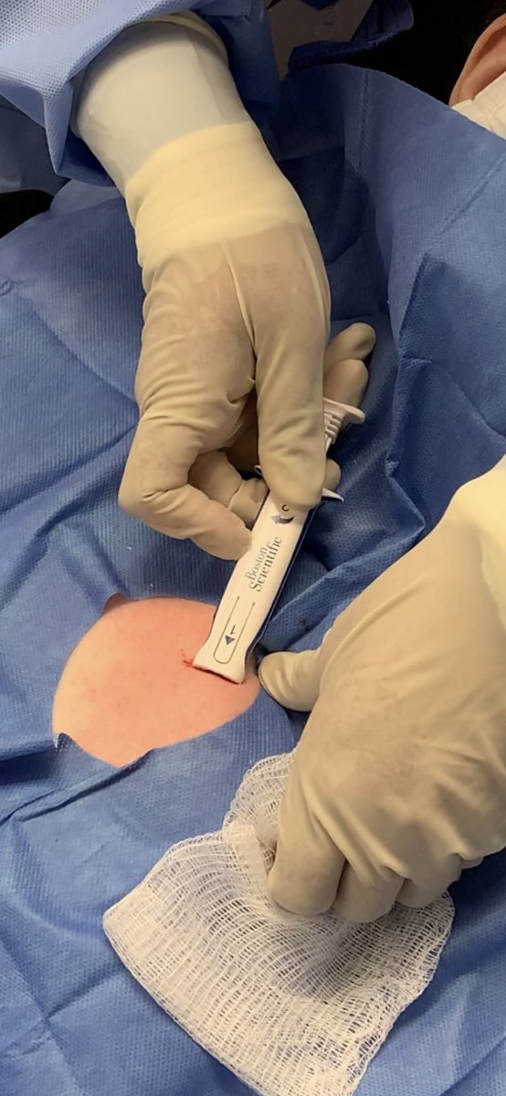 Drdevignair's tweet photo. Implanted my first Lux ICM today. Excited about dual-stage algorithm that detects &amp; verifies arrhythmias, providing actionable data for clinical decision-making.Also remote programming capabilities of the device is a significant step forward in diagnostic side of rhythm mngmt. https://t.co/rYXuzBqIh5