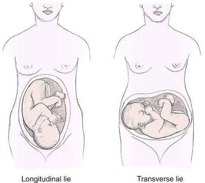 2. Abnormal lie which can be transverse or oblique.Normal lie is longitudinal lie in which the baby is coming out thorough the head. Transverse lie is an abnormal lie as shown in this image.