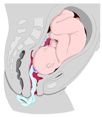 5. Cord prolapse- when the umbilical cord comes out of the uterus with or before the presenting part of the baby. The concern with cord prolapse is that pressure on the cord from the baby will compromise blood flow to the baby.