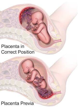 4. Placenta previa- When the placenta covers the opening in the mother's cervix.