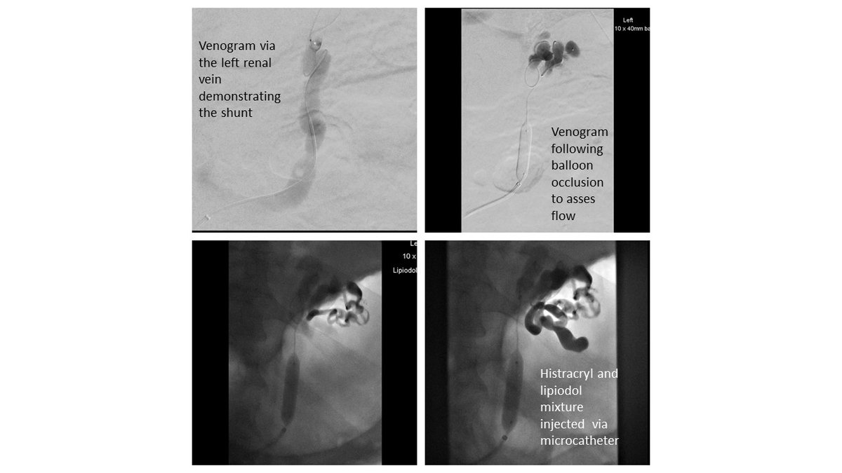 The British Society of Interventional Radiology tweet media