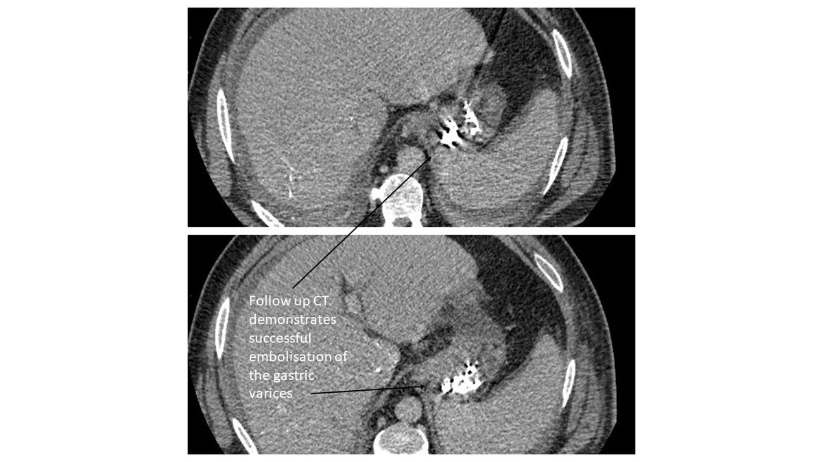 The British Society of Interventional Radiology (@bsir_news) on Twitter photo Start of the week from Manchester ( <a href="/ukradiologist/">Anantha Krishnan</a> ) with a case demonstrating BRTO. Bleeding gastric varices are always challenging and BRTO can be life saving. Knowledge of anatomy, variants and familiarity with Histracryl is vital ! <a href="/nirmalkakani/">Nirmal Kakani</a> @Ed_Lake <a href="/Rosie1878/">Rosie Cadwallader</a> Start of the week from Manchester ( <a href="/ukradiologist/">Anantha Krishnan</a> ) with a case demonstrating BRTO. Bleeding gastric varices are always challenging and BRTO can be life saving. Knowledge of anatomy, variants and familiarity with Histracryl is vital ! <a href="/nirmalkakani/">Nirmal Kakani</a> @Ed_Lake <a href="/Rosie1878/">Rosie Cadwallader</a>